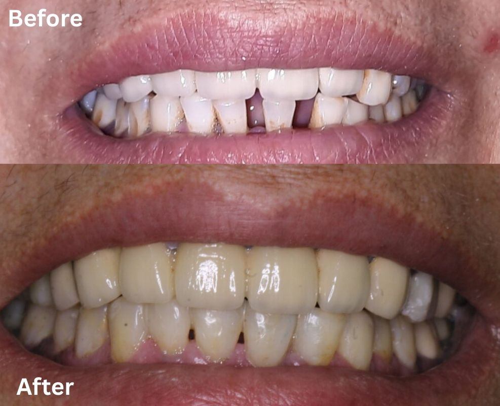 Worn lower teeth before additive dental treatment