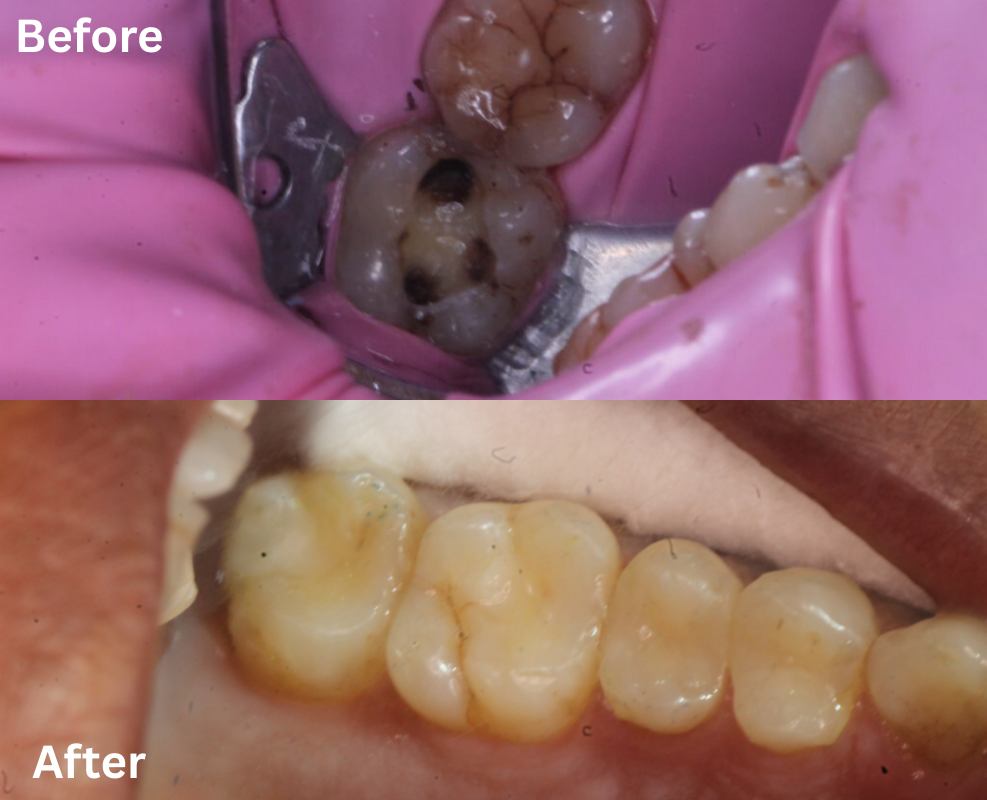 Comparison of dental filling materials