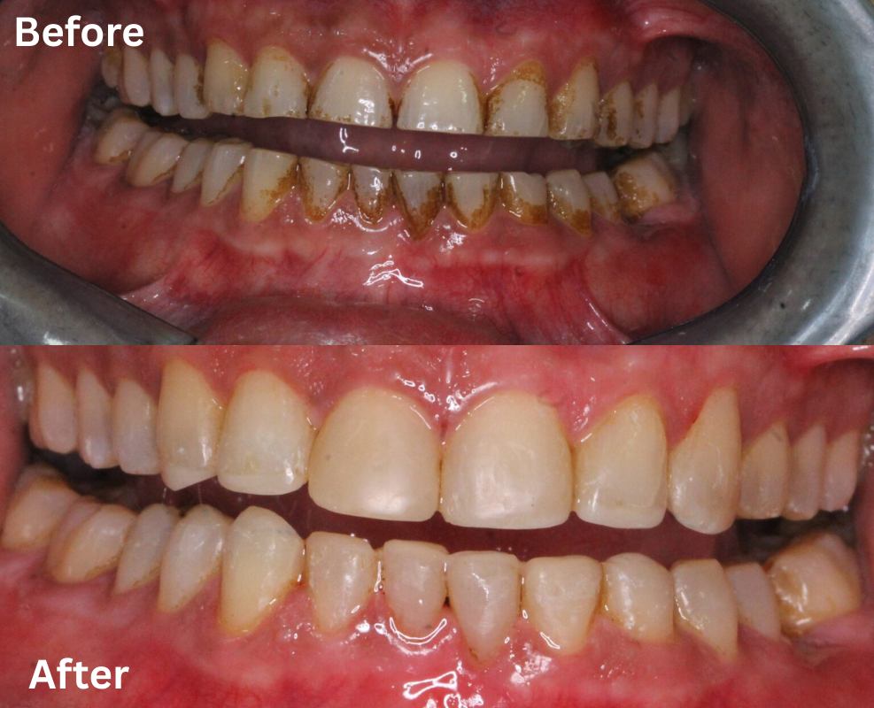 Teeth showing wear from grinding and clenching