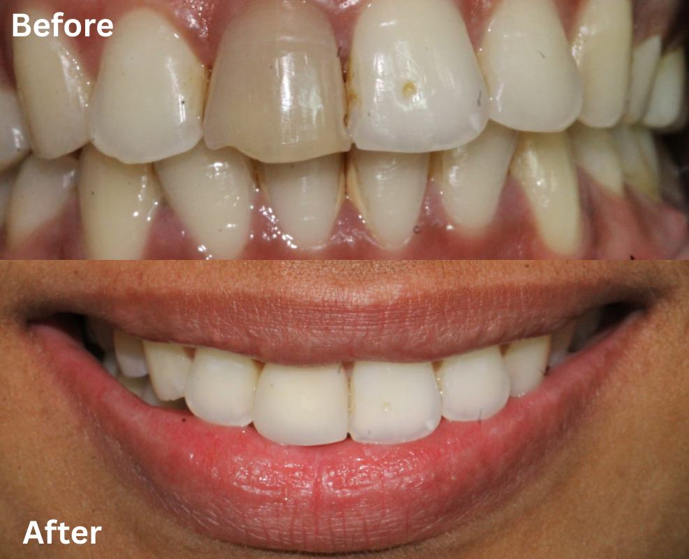 Before and after a single veneer on a discolored front tooth
