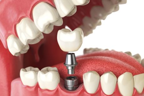 Dental Implants