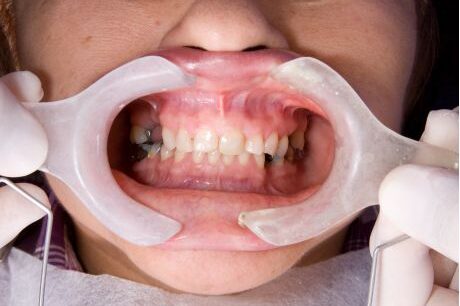 full mouth rehabilitation