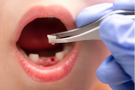 milk tooth removal